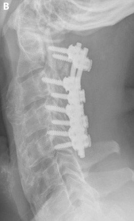 Post-operative lateral cervical spine x-ray demonstrating a laminectomy (removal of the bones that make up the posterior portion of the spinal canal) and instrumented stabilization of the cervical spine with lateral mass screws and rods. The laminectomy effectively increases the size of the spinal canal