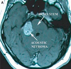 Pre-operative axial T1 MRI with contrast demonstrating a large acoustic neuroma compressing the brainstem