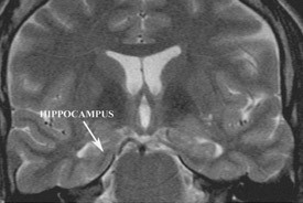 Coronal T2 weighted MRI demonstrating the origin of seizure activity (the hippocampus) in a patient with classic temporal lobe epilepsy