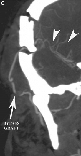 Post-operative coronal CT angiogram demonstrating the patent bypass graft and the revascularized middle cerebral artery territory (arrowheads)