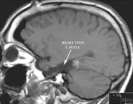 Post-operative sagittal T1 weighted MRI demonstrating resection of the hippocampus