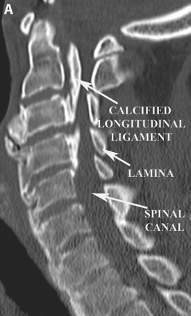 A sagittal CT scan of the cervical spine demonstrating severe narrowing of the spinal canal due to calcification of the posterior longitudinal ligament.Note that bones that make up the back of the spinal canal are called the lamina