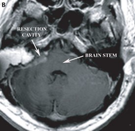 RMN axial T1 postoperatoria con contraste que demuestra la cavidad de resección quirúrgica y la resolución de la compresión del tronco cerebral