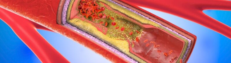 How does carotid artery disease cause a stroke