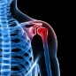 El New York Spine Institute puede tratar el dolor de hombro