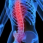 New York Spine Institute Can Treat Lumbar Spine / Lower Back Pain