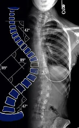 X-ray image showing patient with scoliosis