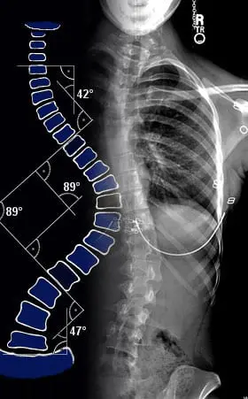 X-Ray בילד ווייזונג אַ פּאַציענט מיט סקאָליאָסיס