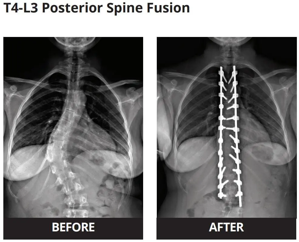 Antes y después de la fusión espinal