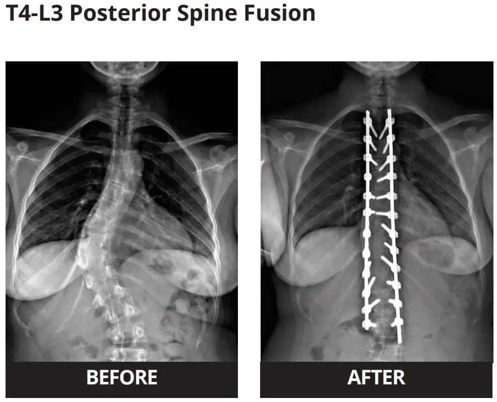 Antes y después de la fusión vertebral