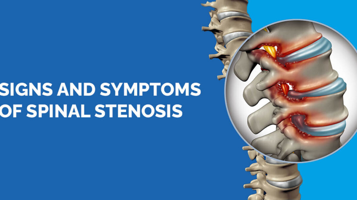 https://www.nyspine.com/wp-content/uploads/2022/07/01-sings-and-symptoms-of-spinal-stenosis-1200x675.jpg