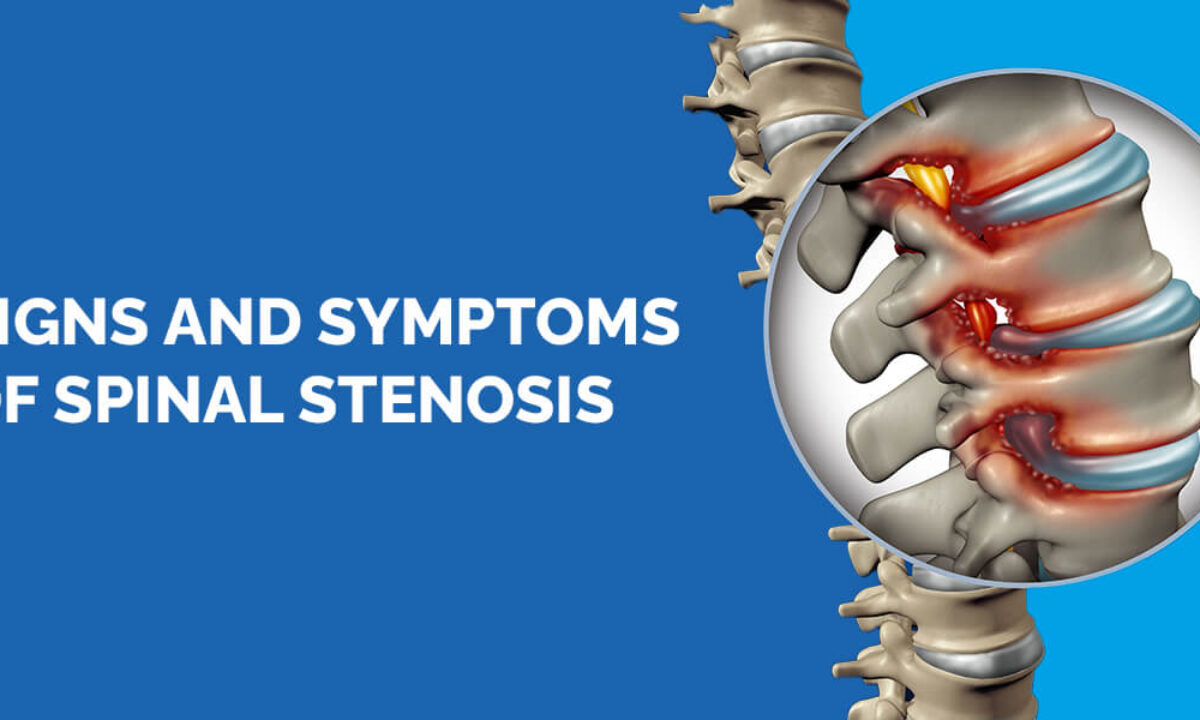 https://www.nyspine.com/wp-content/uploads/2022/07/01-sings-and-symptoms-of-spinal-stenosis-1200x720.jpg
