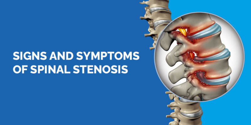 સ્પાઇનલ સ્ટેનોસિસના ચિહ્નો અને લક્ષણો