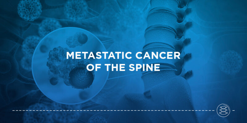 Metastatic Cancer of the Spine