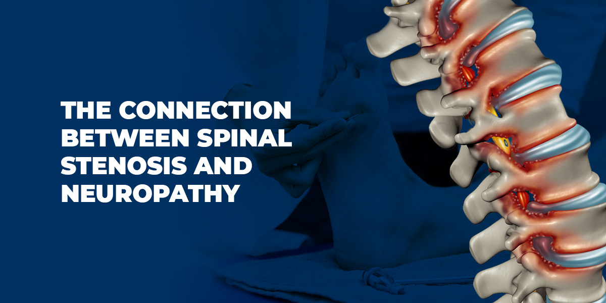 The connection between spinal stenosis and neuropathy