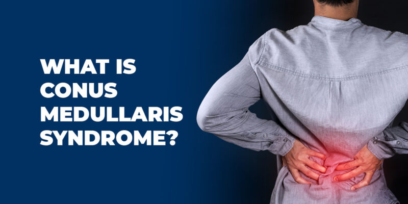 What is Conus Medullaris Syndrome