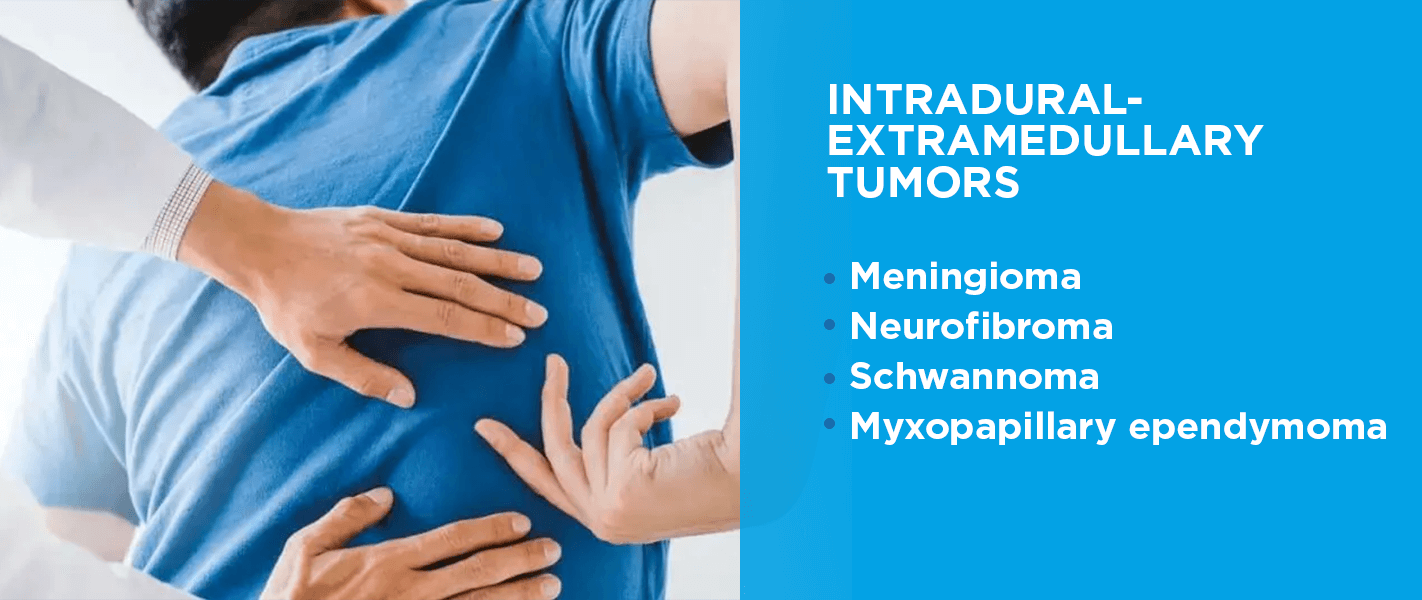 Tumores intradurales-extramedulares 