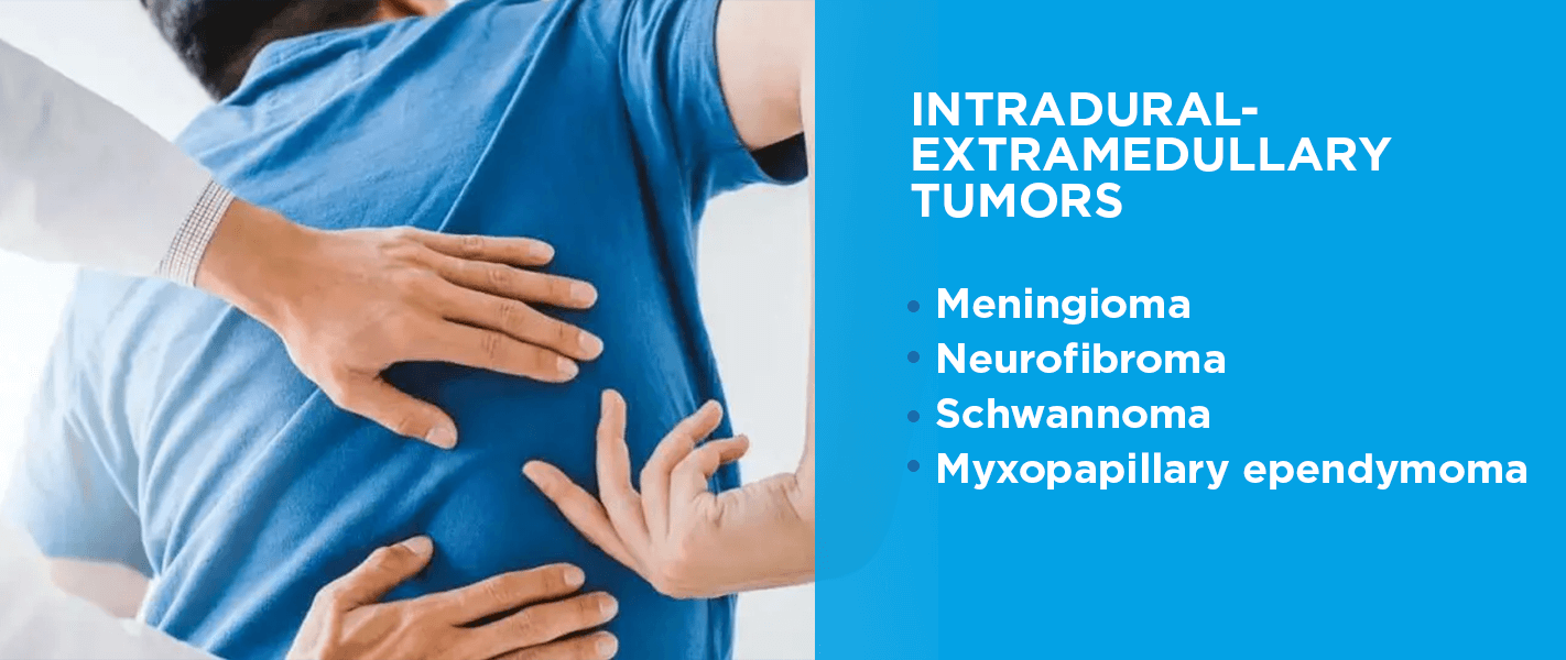 Intradural-extramedullary tumors  