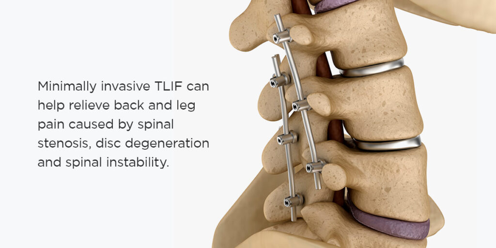 Afecciones tratadas con TLIF mínimamente invasiva